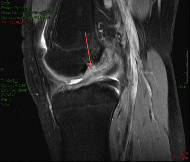 An MRI scan demonstrating a ruptured ACL