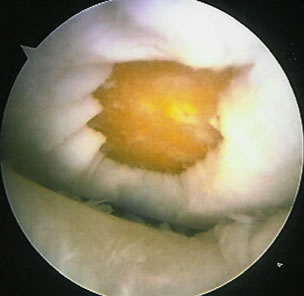 Chondral defect