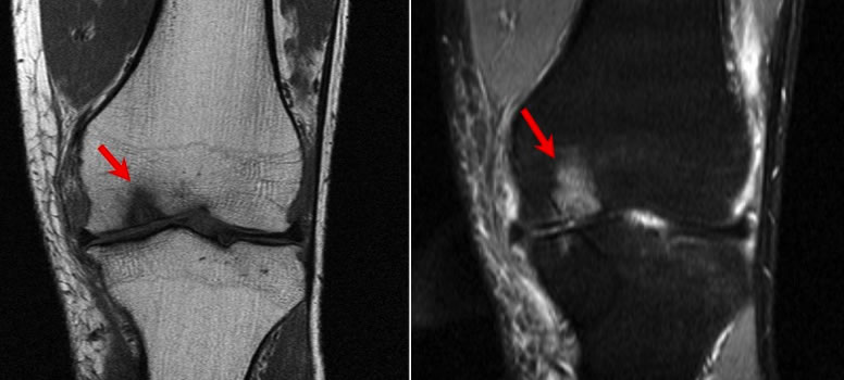 MRI scan chondral injuries