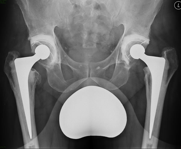 Hip Replacement Surgery Xray