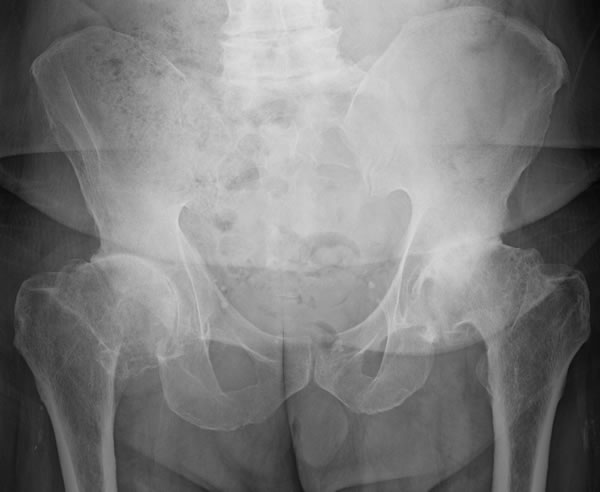 Hip Xray