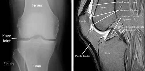 Xrays of knee joint