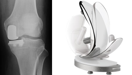 Medial Compartment OA