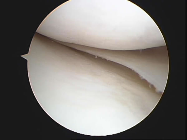 Normal meniscus