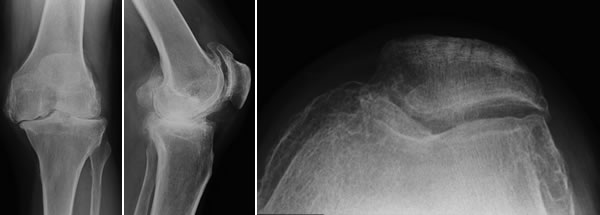 Osteoarthritis Xrays