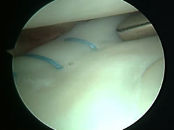 Repaired meniscus