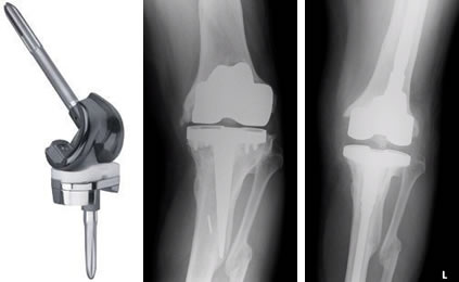 Revision Total Knee Replacement