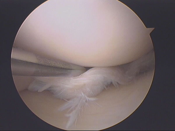 Torn meniscus
