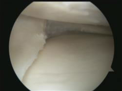 Trimmed meniscus